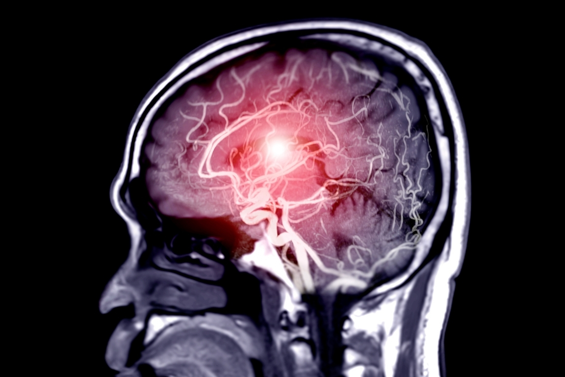 Neurocirugía